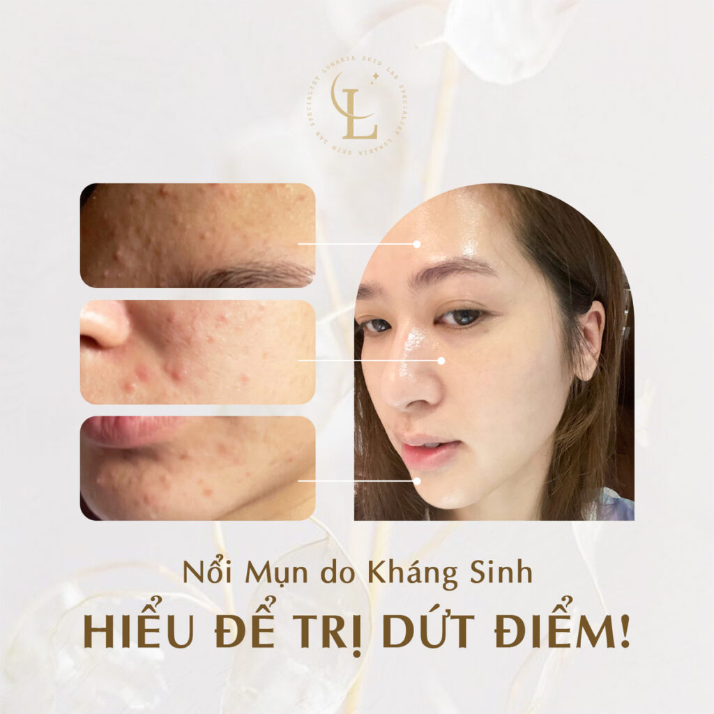 Trung tâm điều trị mụn uy tín Đà Nẵng giải đáp lý do kháng sinh gây mụn