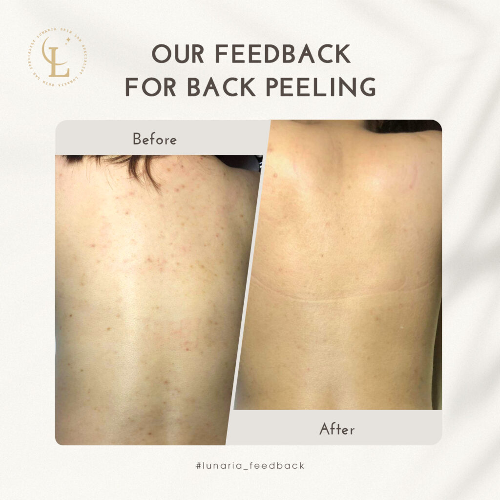 Back Peeling treatment at Lunaria - a trusted skin clinic in Da Nang