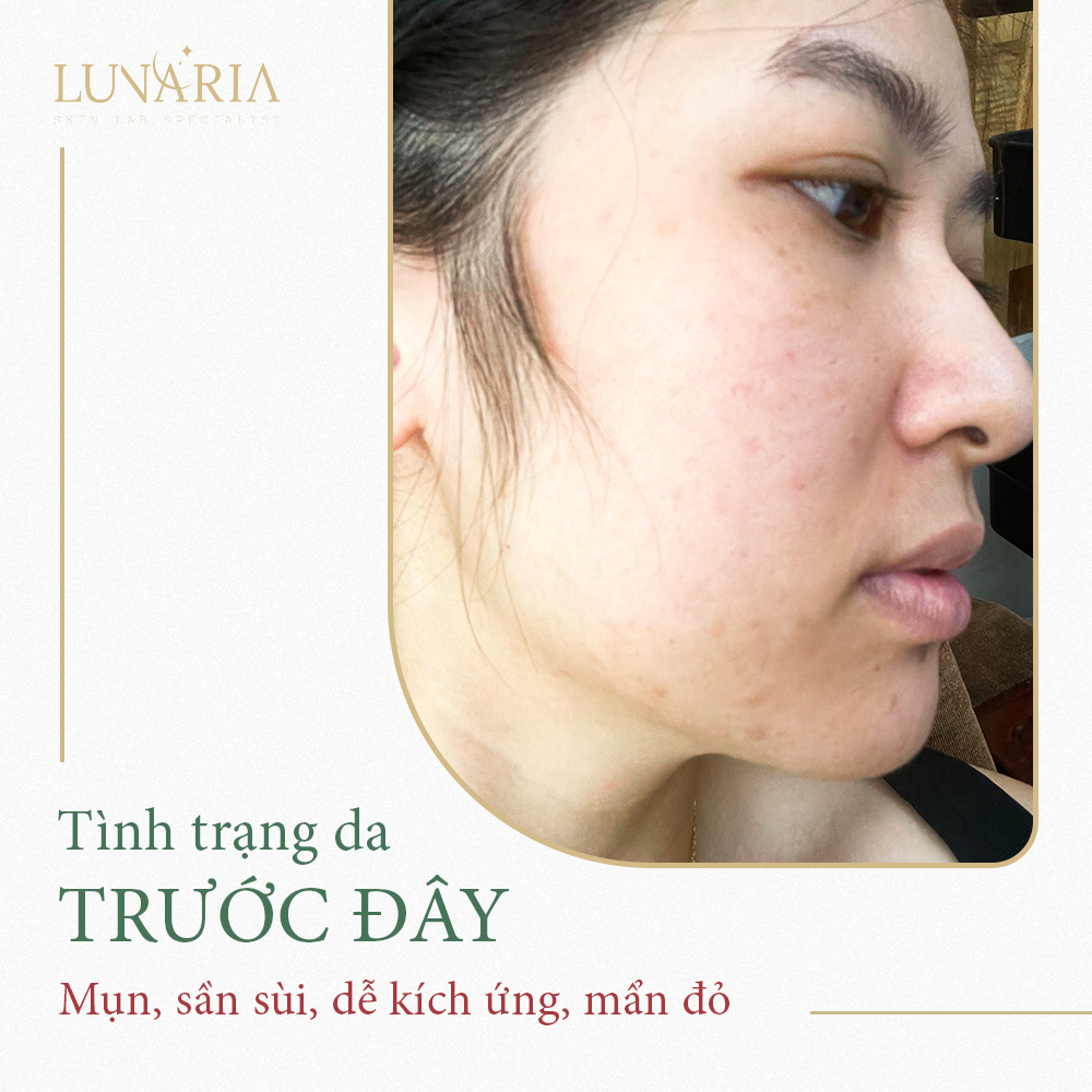 Tình trạng da trước khi có clinic uy tín Lunaria 