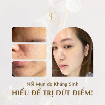 Trị mụn uy tín Đà Nẵng do kháng sinh