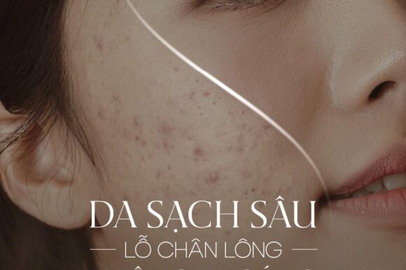 Spa Nặn Mụn Tại Đà Nẵng: Vì Sao Tự Nặn Mụn Có Thể Khiến Da Tệ Hơn?
